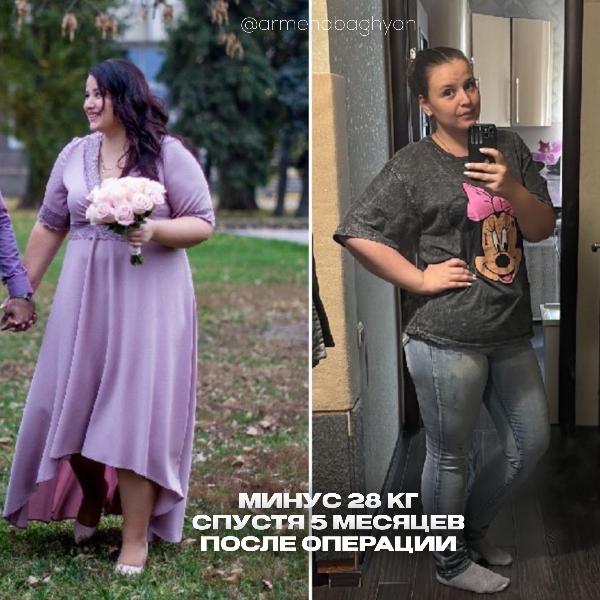 Планирование беременности после бариатрической операции